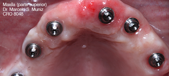 implantes
